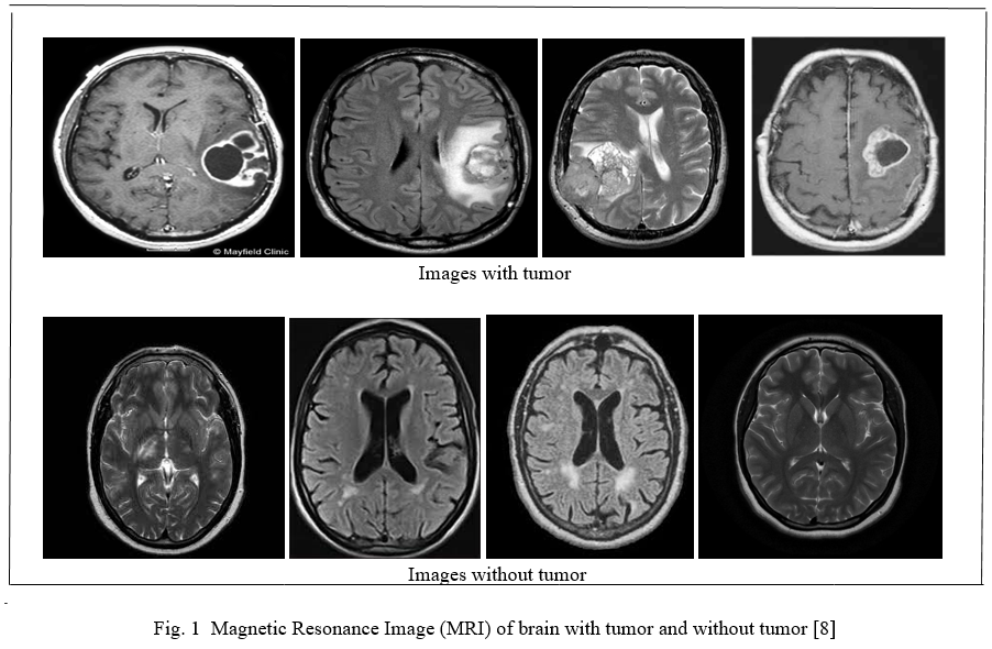 brain tumor detection research papers